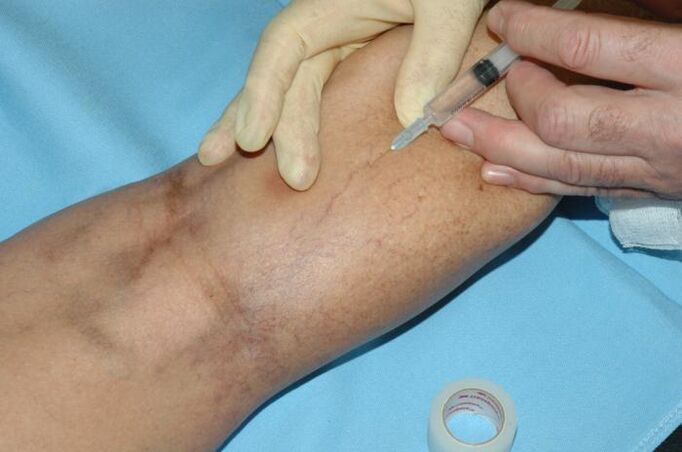 Sklerotherapie