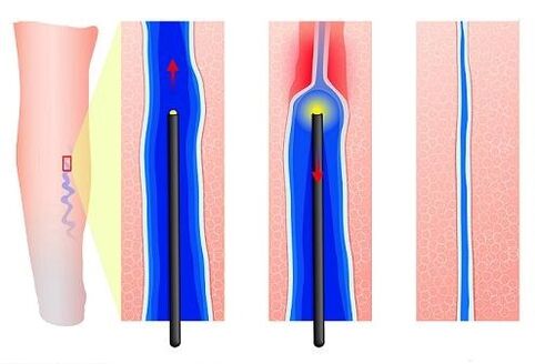 Laserkoagulation