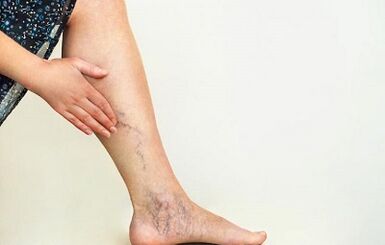 wie man Krampfadern der unteren Extremitäten behandelt
