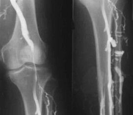 Diagnosemöglichkeiten bei Krampfadern der Extremitäten