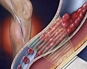 Krampfadern der tiefen Venen der unteren Extremitäten